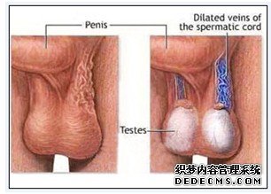 精索静脉曲张图